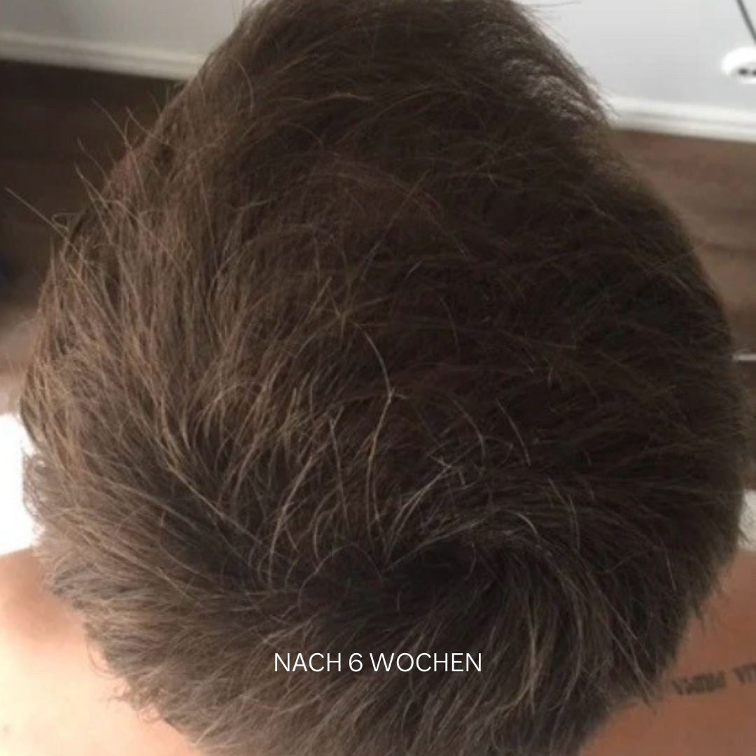 Set bei Haarausfall - Image 9