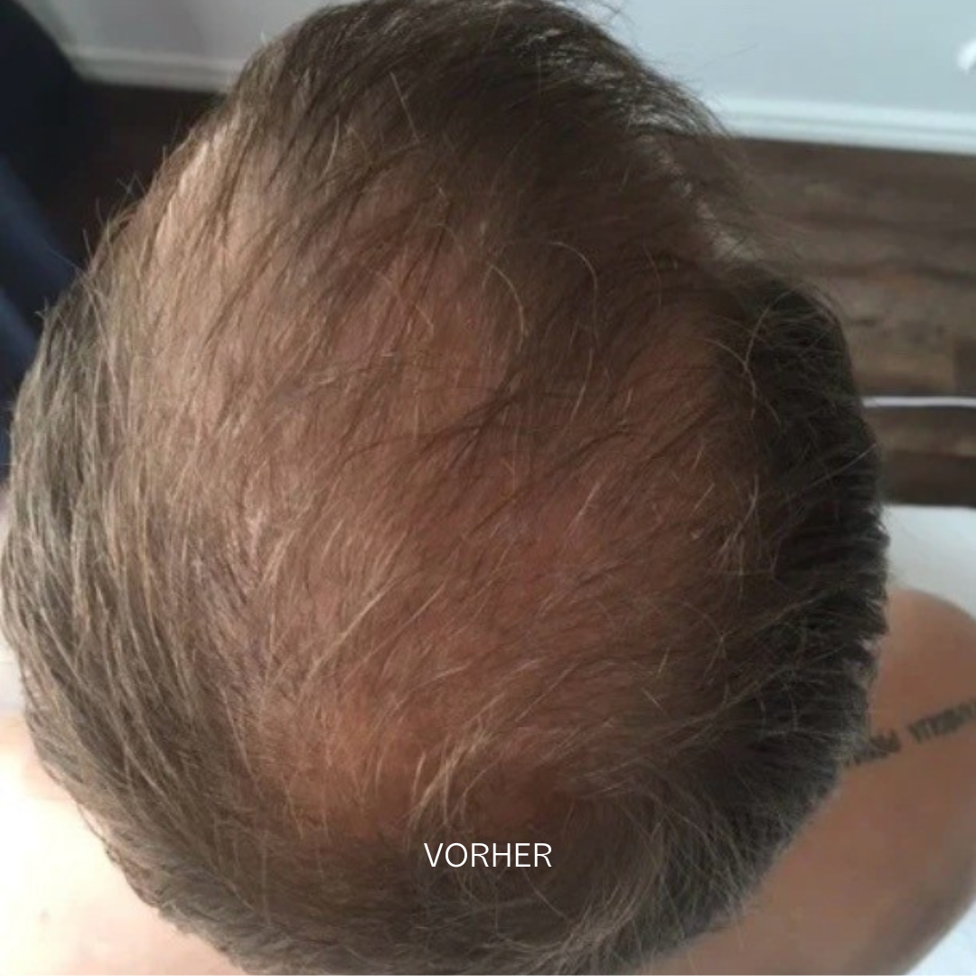 Set bei Haarausfall - Image 8